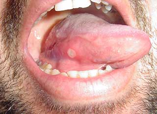 علاج القرح الفم